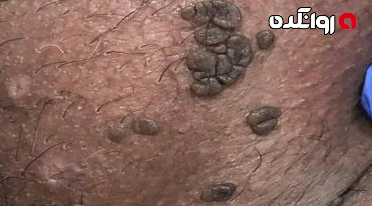 همه چیز در مورد HPV و زگیل ناحیه تناسلی
